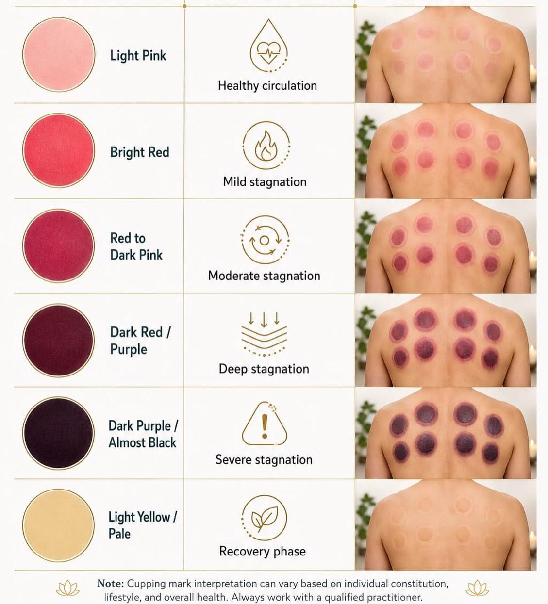 การครอบแก้ว (Cupping Therapy)