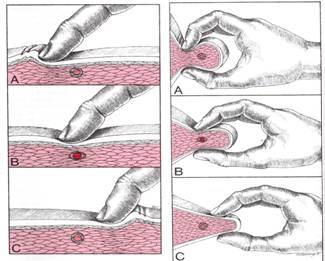 การฝังเข็มในโรคกล้ามเนื้อหดเกร็ง (Dry needling puncture in Myofascial pain syndrome)