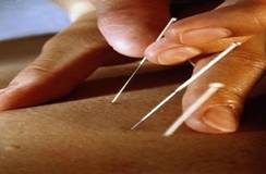 การฝังเข็มในโรคกล้ามเนื้อหดเกร็ง (Dry needling puncture in Myofascial pain syndrome)